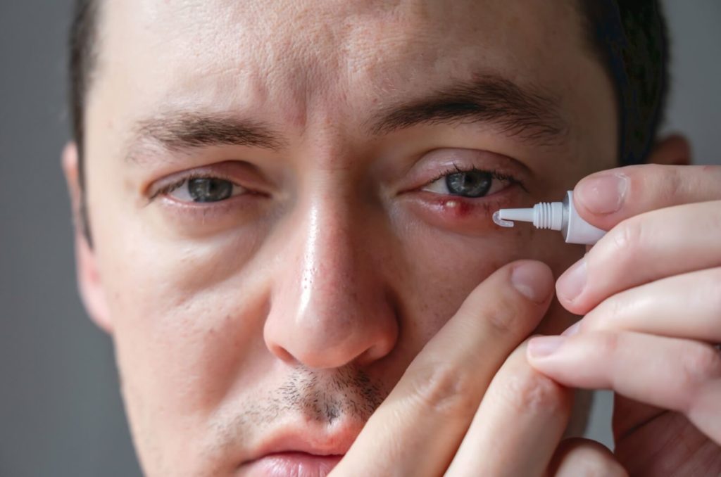 A close-up image of a man putting ointment on his painful-looking stye.